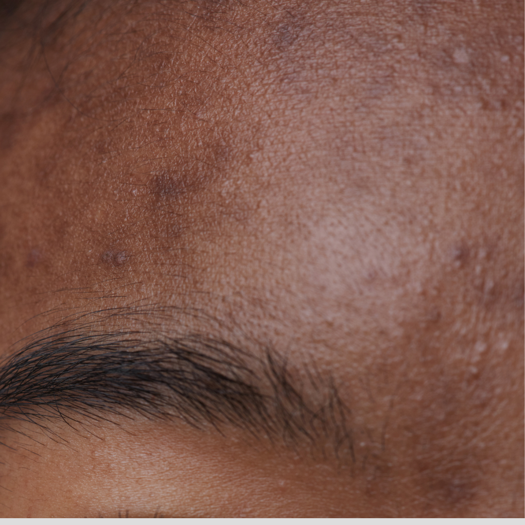 Dark Marks & Hyperpigmentation